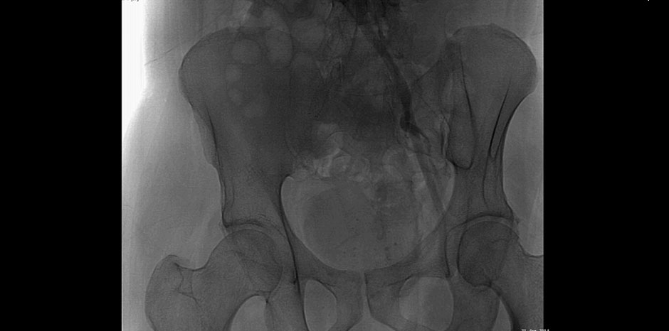 RIGHT ILIAC STENT OCCLUDED

