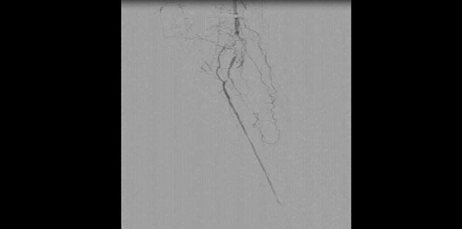 RT POPLITEAL OCCLUSION
