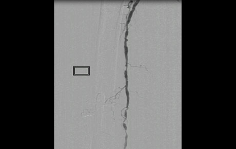 SFA AND POPLITEAL ANGIOPLASTY