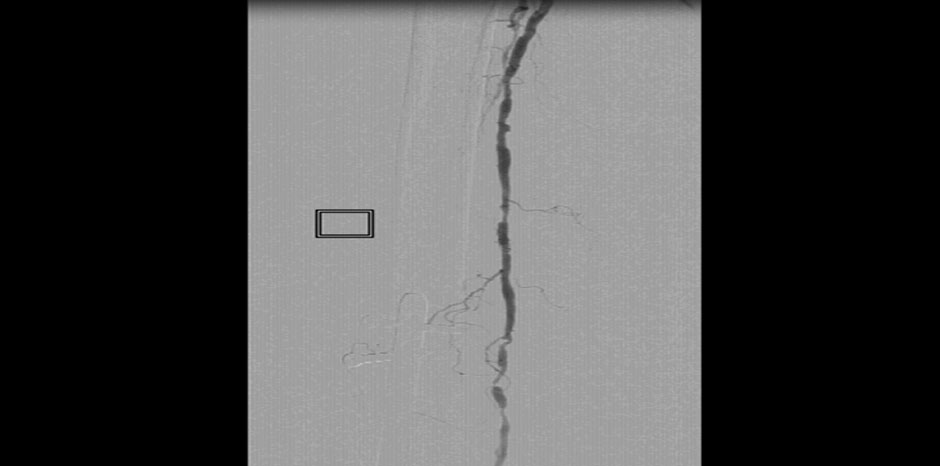 RT SFA DIFFUSE DISEASE
