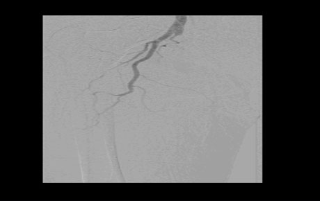 FLUSH SFA OCCLUSION