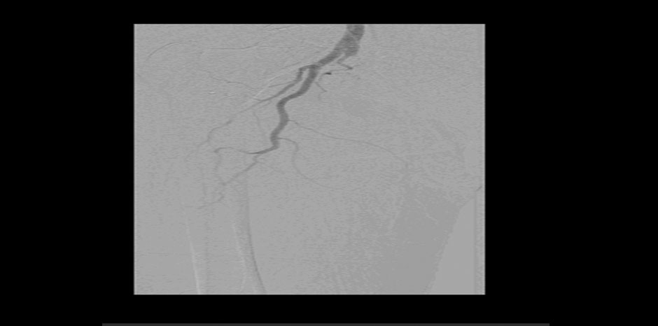 RT SFA OCCLUSION
