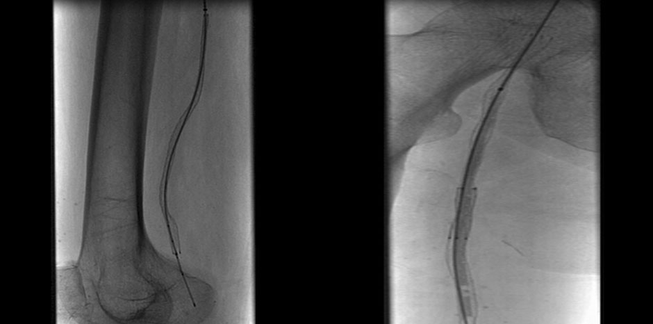 SFA AND POPLITEAL STENTING, PROXIMAL STENT BEING DEPLOYED

