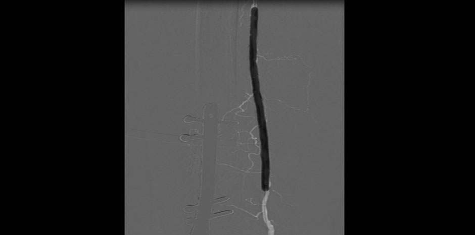 SFA ANGIOPLASTY
