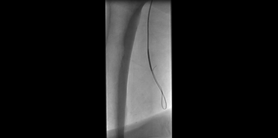 SFA ANGIOPLASTY
