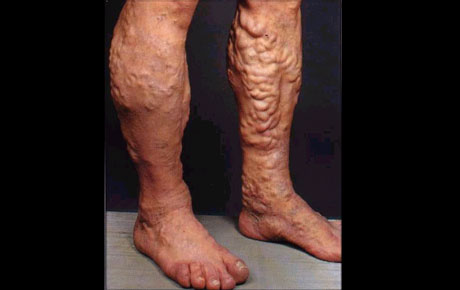 Varicose Veins