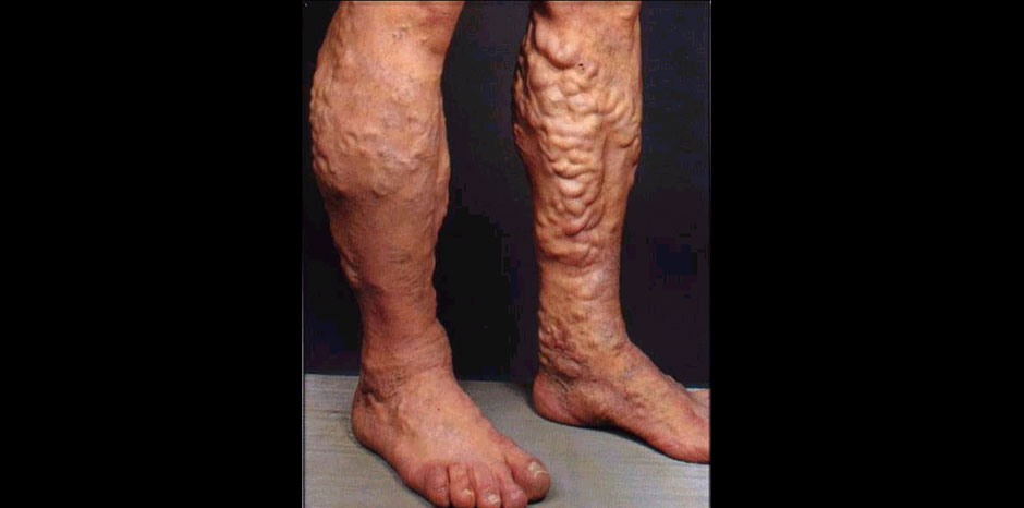 Varicose veins1