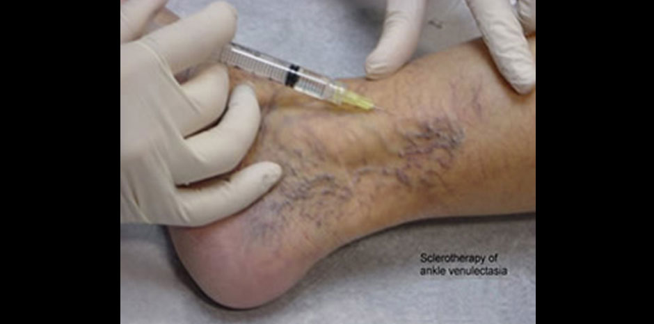 Varicose veins3